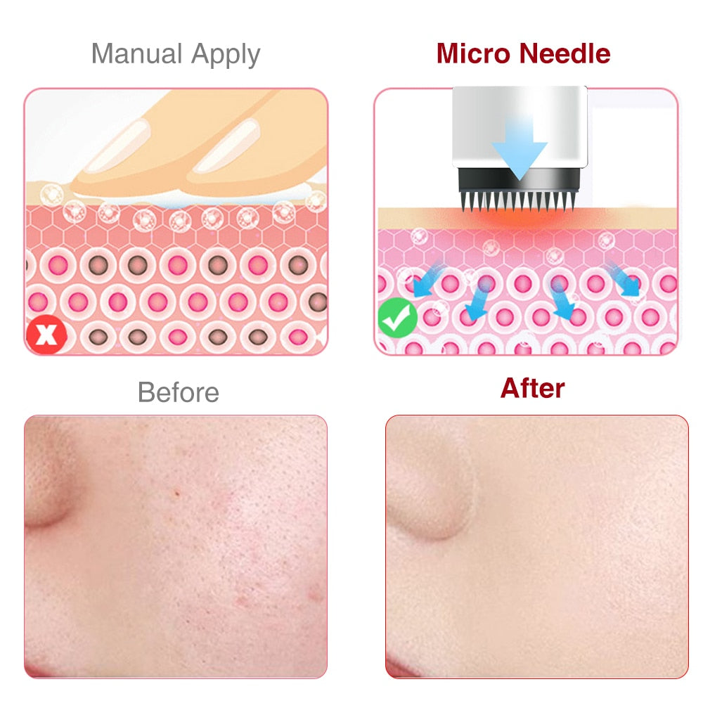 Micro Needle Dermapen for Face Tightening, Scar Reduction, and Wrinkle Removal